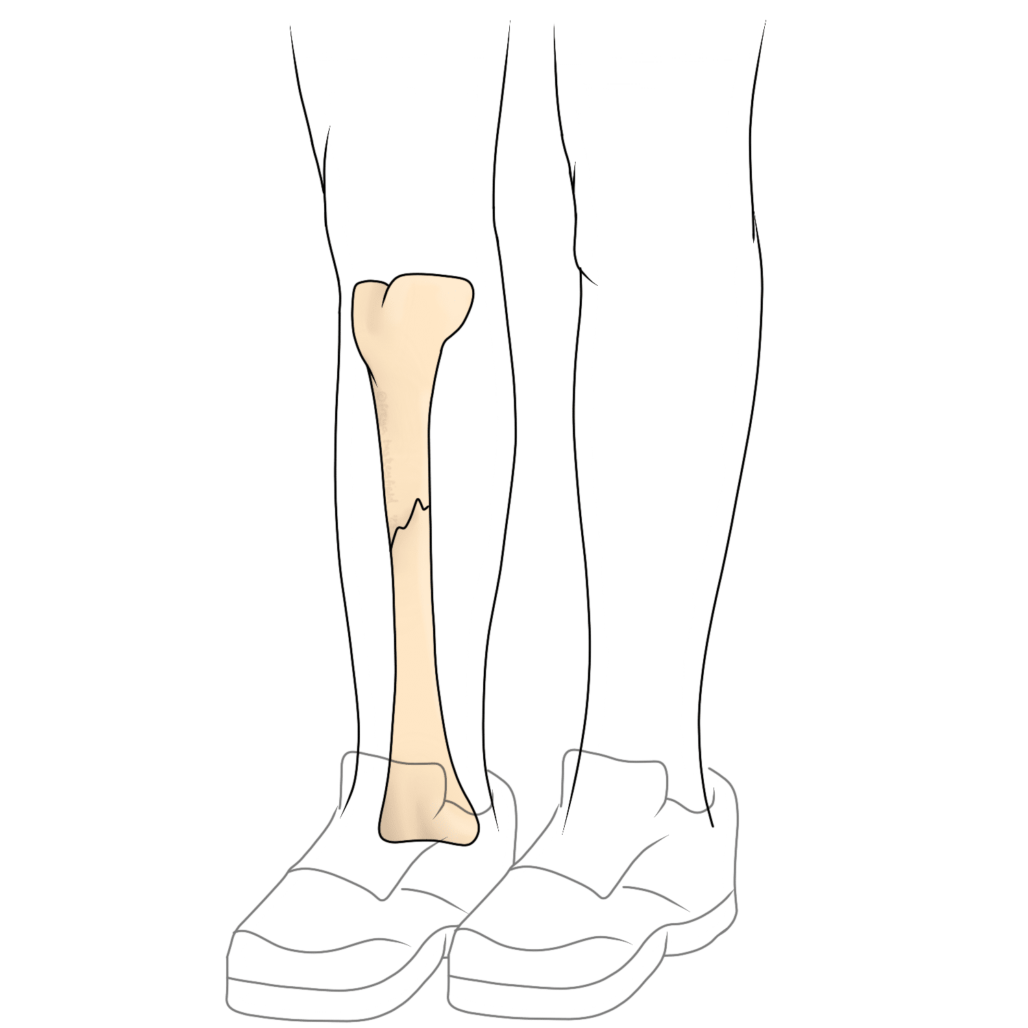 Fracture for Shelby