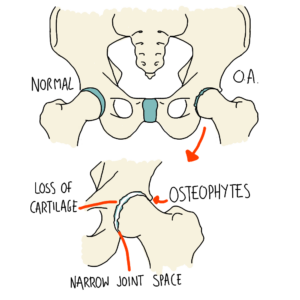 Hip and Knee Osteoarthritis [Blog Post Kit]