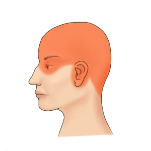 Cervicogenic Headaches [Blog Post Kit]